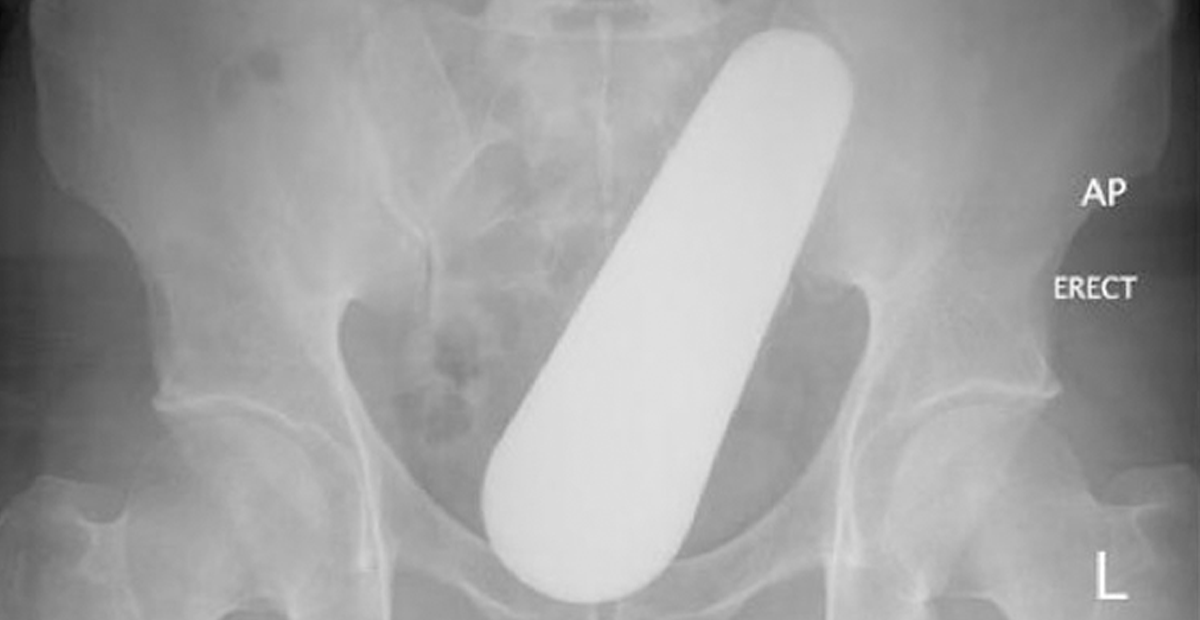 SE INTRODUCE OBJETO EN EL RECTO Y ACABA EN ÁREA DE URGENCIAS