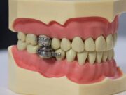 Crean aparato que bloquea la mandíbula para bajar de peso