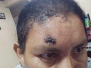 Mexicana deportada sufre secuelas de ser baleada por la Patrulla Fronteriza