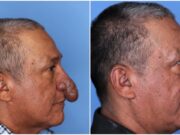 Tras ver la nariz de un pintor que trabajaba en su casa, cirujano le ofrece corregir su padecimiento