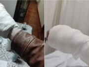 Ponen yeso a paciente en el IMSS y no se puede quitar su chamarra; historia se hace viral