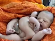 Bebé con 4 piernas y 4 brazos nace en la India
