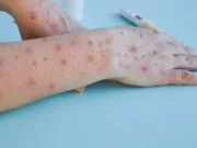 Estos estados presentan casos de Viruela del Mono