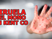Viruela del mono, una amenaza de salud en el Condado de Kent