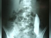 Hoja de cuchillo de 15 cm se queda “deambulado” dentro del abdomen de un hombre