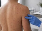 Confirman primer caso de sarampión en Ottawa en más de 30 años